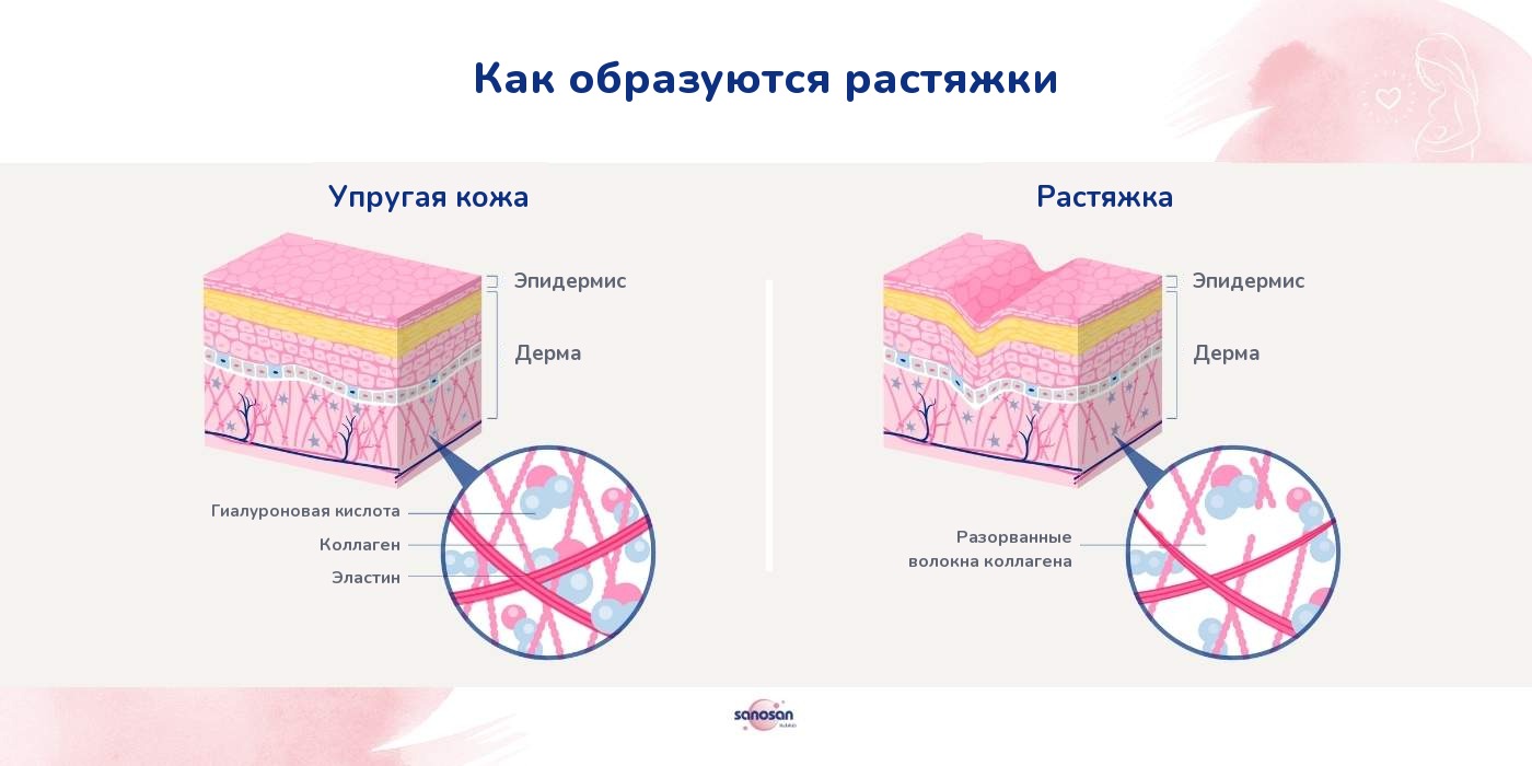 Как образуются растяжки: срез кожи — упругая кожа и растяжка, волокна коллагена и эластина